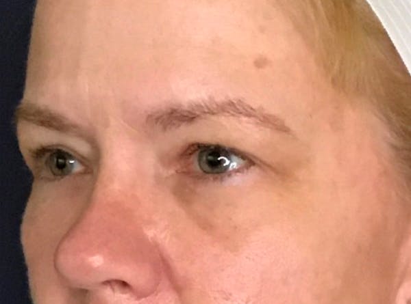Blepharoplasty (Eyelid Surgery) Before & After Gallery - Patient 13733123 - Image 3