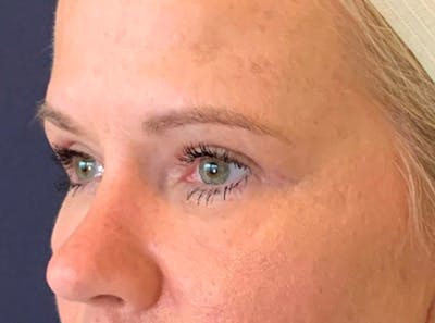 Blepharoplasty (Eyelid Surgery) Before & After Gallery - Patient 13733123 - Image 4