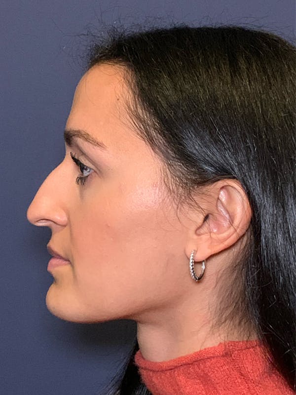 Rhinoplasty Before & After Gallery - Patient 52519316 - Image 5