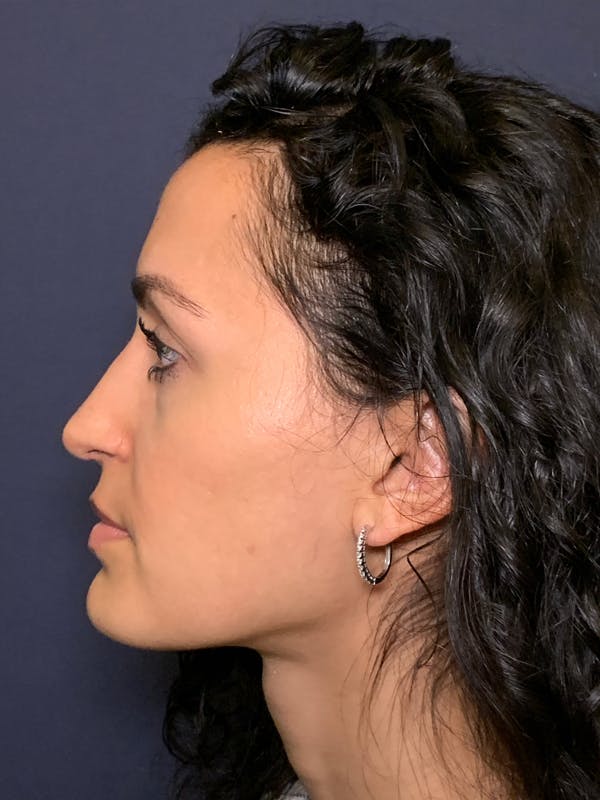 Rhinoplasty Before & After Gallery - Patient 52519316 - Image 6