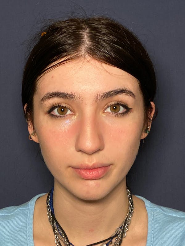 Patient 3 Before Rhinoplasty