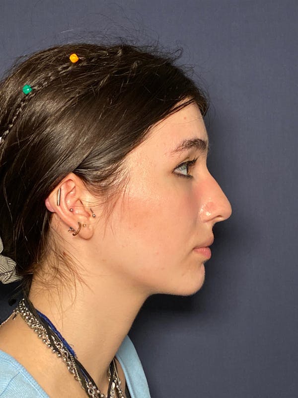 Rhinoplasty Before & After Gallery - Patient 52519317 - Image 3