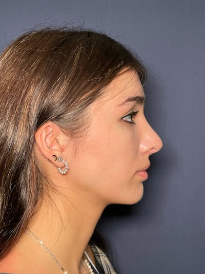 Rhinoplasty Before & After Gallery - Patient 52519317 - Image 4