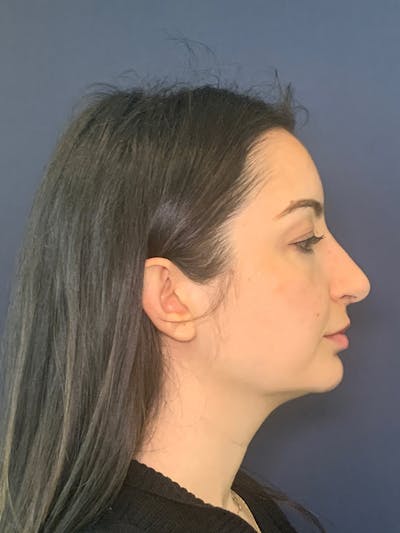 Rhinoplasty Before & After Gallery - Patient 52519319 - Image 4