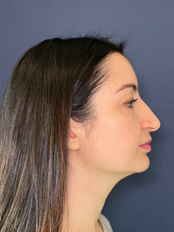 Rhinoplasty Before & After Gallery - Patient 52519319 - Image 3