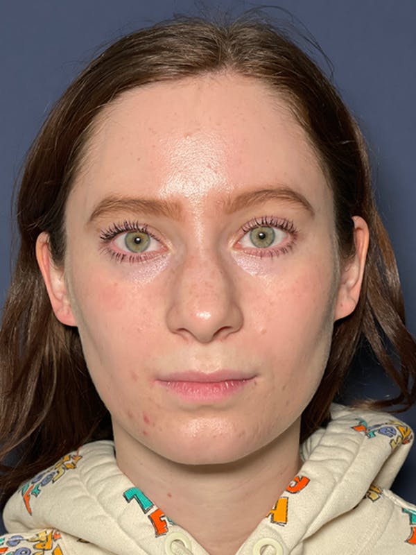 Septoplasty