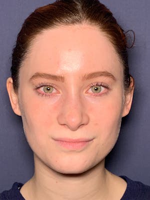 Septoplasty