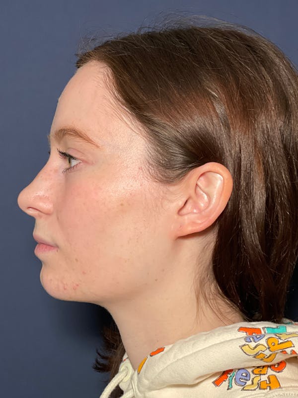 Septoplasty Before & After Gallery - Patient 52520115 - Image 3
