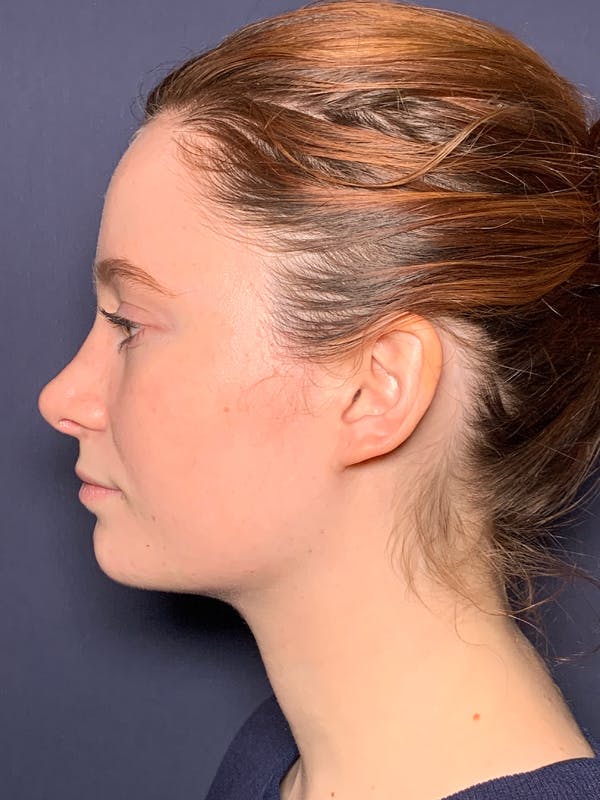 Rhinoplasty Before & After Gallery - Patient 141137974 - Image 4