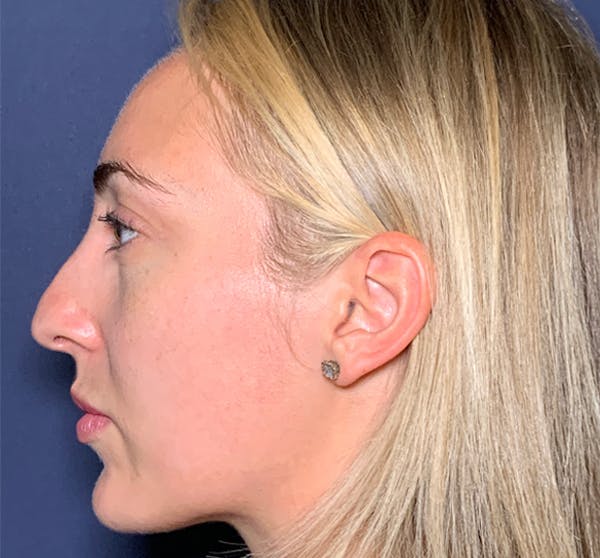 Patient 4 Before Non-Surgical Rhinoplasty