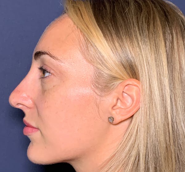 Patient 4 Before Non-Surgical Rhinoplasty