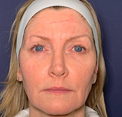 NaturaBrow® Before & After Gallery - Patient 141112703 - Image 1