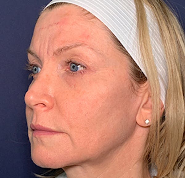 NaturaBrow® Before & After Gallery - Patient 141112703 - Image 3