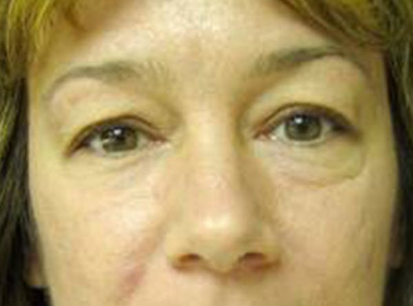 Blepharoplasty (Eyelid Surgery) Before & After Gallery - Patient 4447926 - Image 1