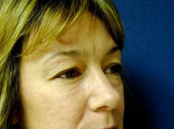 Blepharoplasty (Eyelid Surgery) Before & After Gallery - Patient 4447926 - Image 3