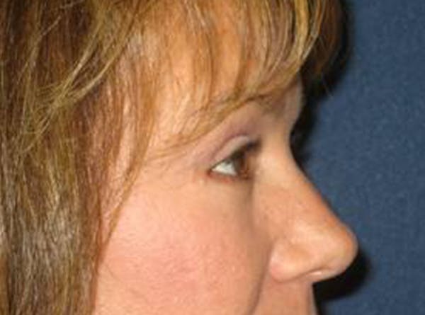 Blepharoplasty (Eyelid Surgery) Before & After Gallery - Patient 4447926 - Image 4