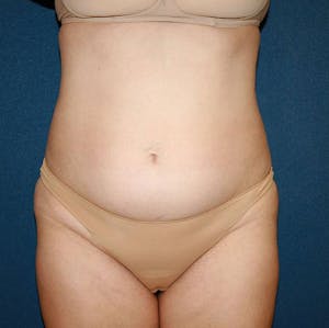 Before and after of a NYC tummy tuck