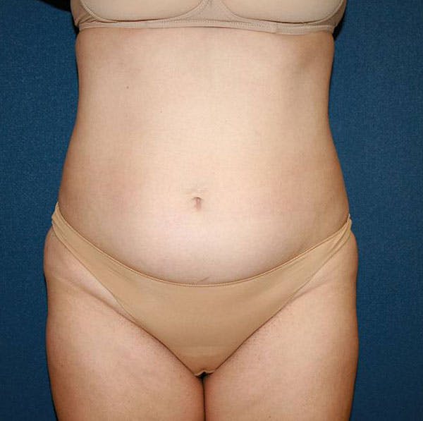 Tummy Tuck (Abdominoplasty) Before & After Gallery - Patient 4448621 - Image 3