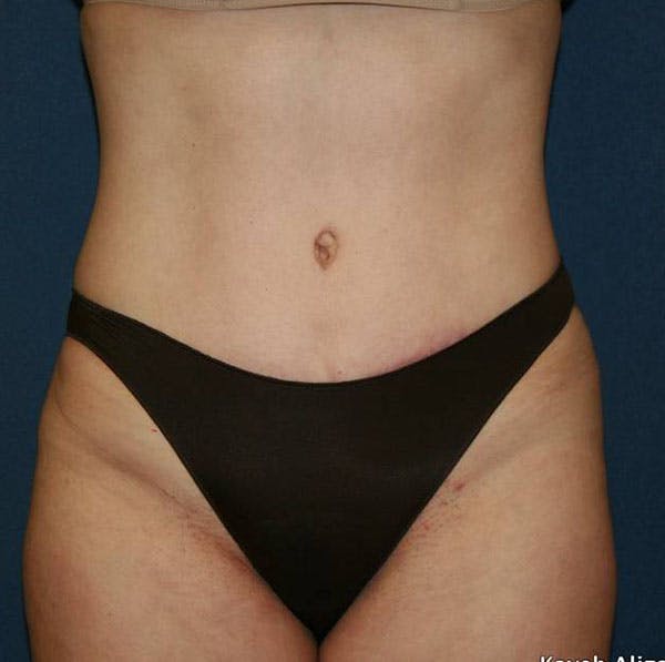 Tummy Tuck (Abdominoplasty) Before & After Gallery - Patient 4448621 - Image 4