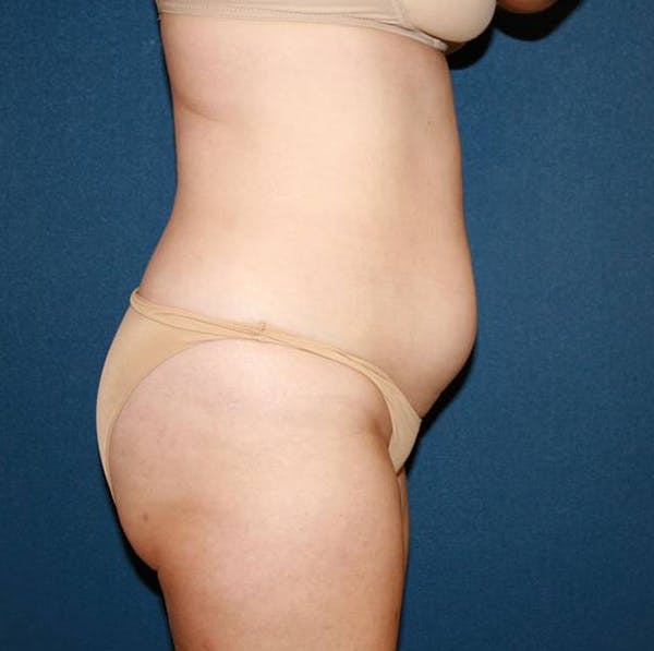 Tummy Tuck (Abdominoplasty) Before & After Gallery - Patient 4448621 - Image 5