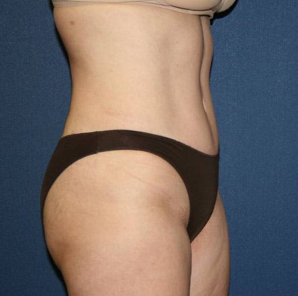 Tummy Tuck (Abdominoplasty) Before & After Gallery - Patient 4448621 - Image 6