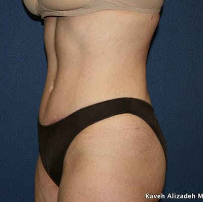 Tummy Tuck (Abdominoplasty) Before & After Gallery - Patient 4448621 - Image 2