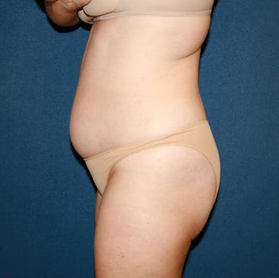 Tummy Tuck (Abdominoplasty) Gallery - Patient 4448621 - Image 1