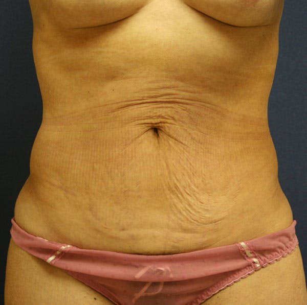 Tummy Tuck (Abdominoplasty) Gallery - Patient 4448620 - Image 1