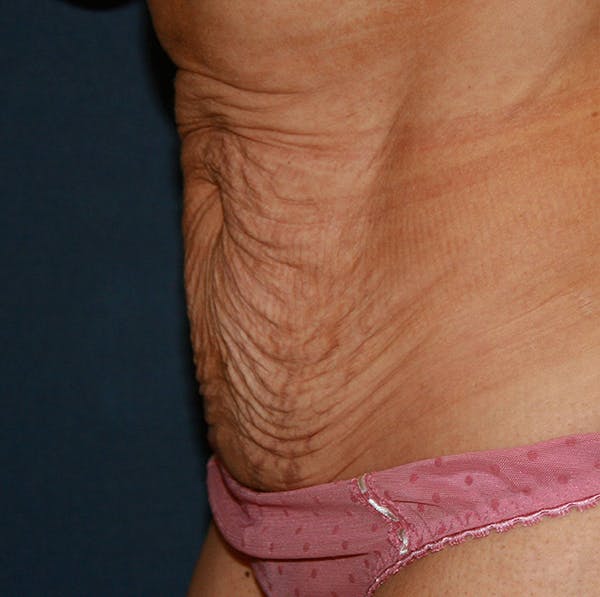 Tummy Tuck (Abdominoplasty) Gallery - Patient 4448620 - Image 3