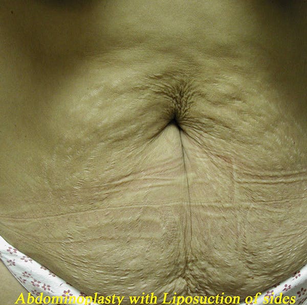 Tummy tuck before picture. Dr. Alizadeh Plastic Surgeon.