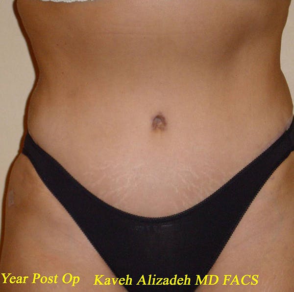 Tummy tuck after picture. Dr. Alizadeh Plastic Surgeon.