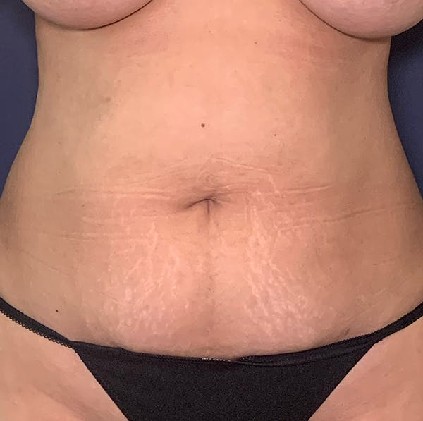 Tummy tuck before - Dr. Alizadeh, NYC