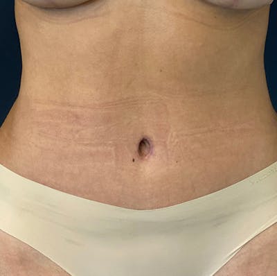 Tummy tuck after, Dr. Alizadeh NYC
