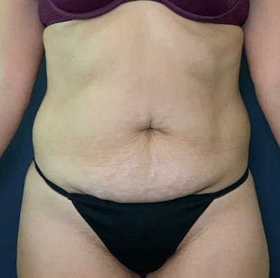 Tummy Tuck (Abdominoplasty) Gallery - Patient 53868591 - Image 1