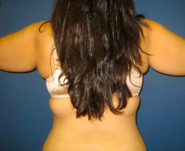 Liposuction Gallery - Patient 4452215 - Image 1
