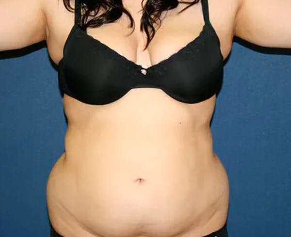Liposuction Before & After Gallery - Patient 4452276 - Image 1