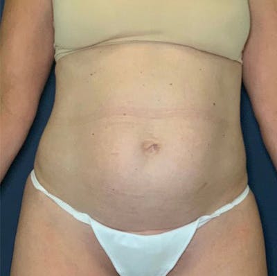 Tummy Tuck (Abdominoplasty) Before & After Gallery - Patient 69074722 - Image 1