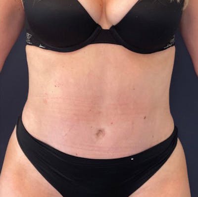 Tummy Tuck (Abdominoplasty) Before & After Gallery - Patient 69074722 - Image 2