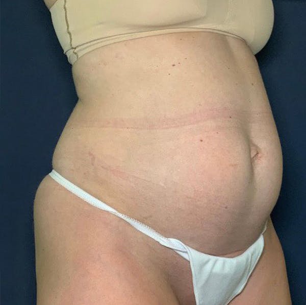 Tummy Tuck (Abdominoplasty) Before & After Gallery - Patient 69074722 - Image 3