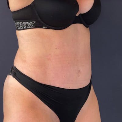 Tummy Tuck (Abdominoplasty) Before & After Gallery - Patient 69074722 - Image 4
