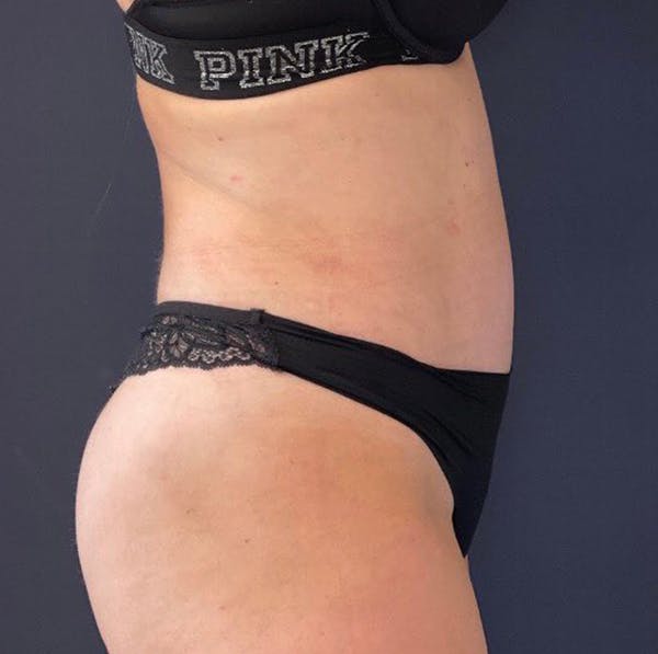 Tummy Tuck (Abdominoplasty) Before & After Gallery - Patient 69074722 - Image 6