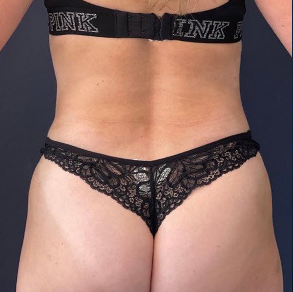 Tummy Tuck (Abdominoplasty) Before & After Gallery - Patient 69074722 - Image 8