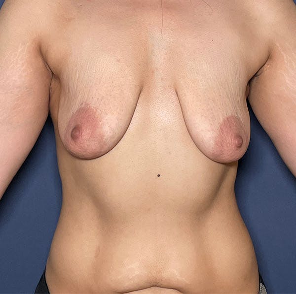 Liposuction Before & After Gallery - Patient 104476499 - Image 1