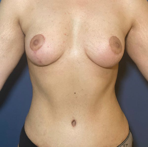 Tummy Tuck (Abdominoplasty) Gallery - Patient 104476534 - Image 2
