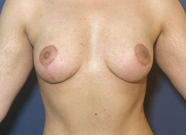NaturaBra™ Mastopexy Before & After Gallery - Patient 104476638 - Image 2