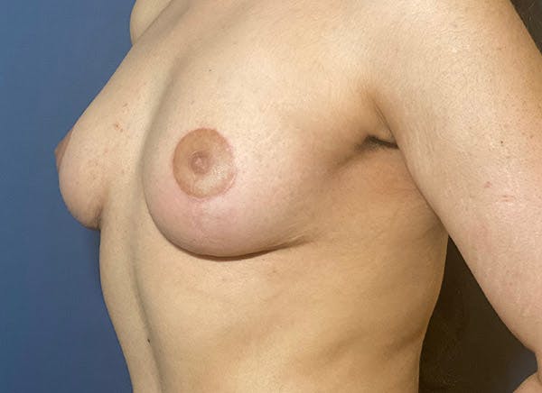 NaturaBra® Mastopexy Before & After Gallery - Patient 104476638 - Image 4