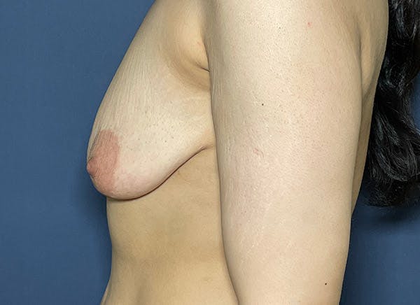 NaturaBra® Mastopexy Before & After Gallery - Patient 104476638 - Image 5