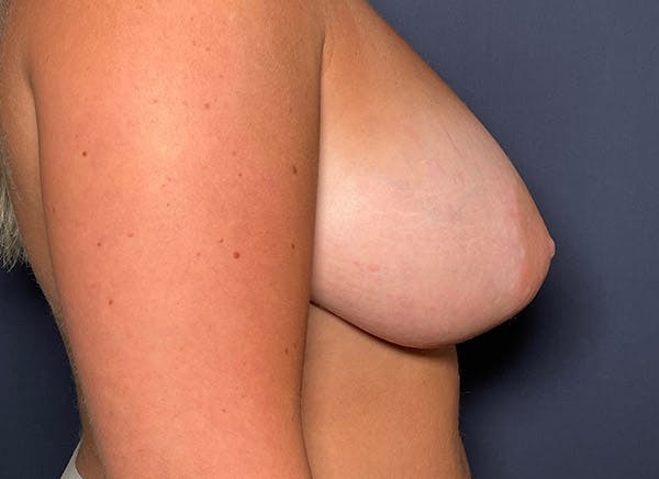 NaturaBra® Mastopexy Before & After Gallery - Patient 104476639 - Image 3