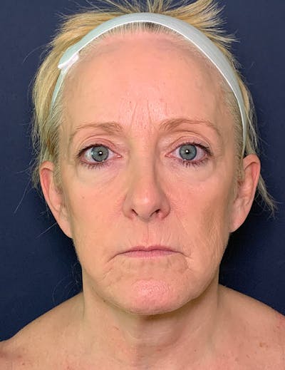 Facelift Before & After Gallery - Patient 104481249 - Image 1