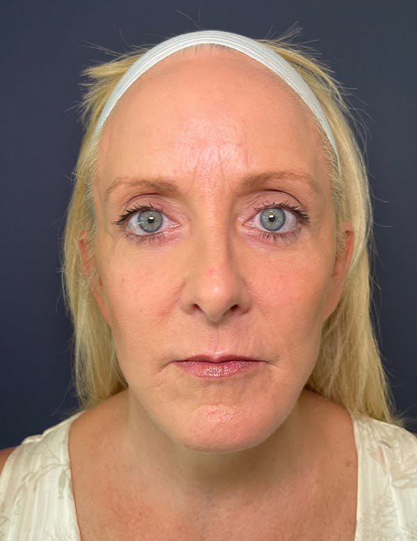 Blepharoplasty (Eyelid Surgery) Before & After Gallery - Patient 104481284 - Image 2